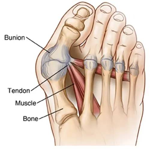 ComfortAlign™ Orthopedic Bunion Corrector